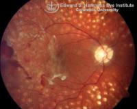 Progressive PDR in a previously treated eye with scatter panretinal photocogulation.